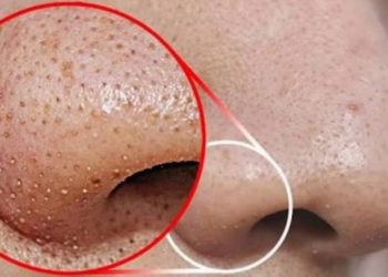 नाकमा ब्ल्याक हेड्सको समस्या छ ? उसोभए यसरी गर्नुहोस् ट्रिटमेन्ट !