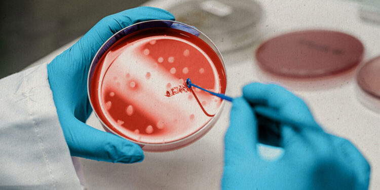 ‘स्टेम सेल’ थेरापीबाट एचआईभी संक्रमित महिलाको सफल उपचार