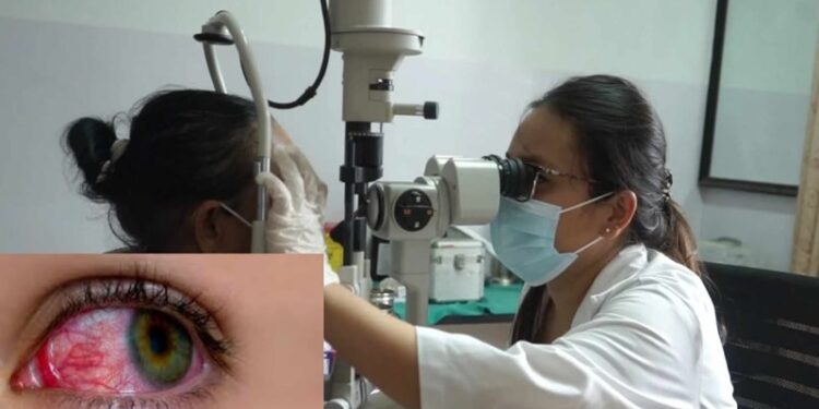 भाइरल आँखा पाक्ने रोगबाट कसरी जोगिने? यस्तो छ लक्षण र उपायहरू… (भिडियो सहित)